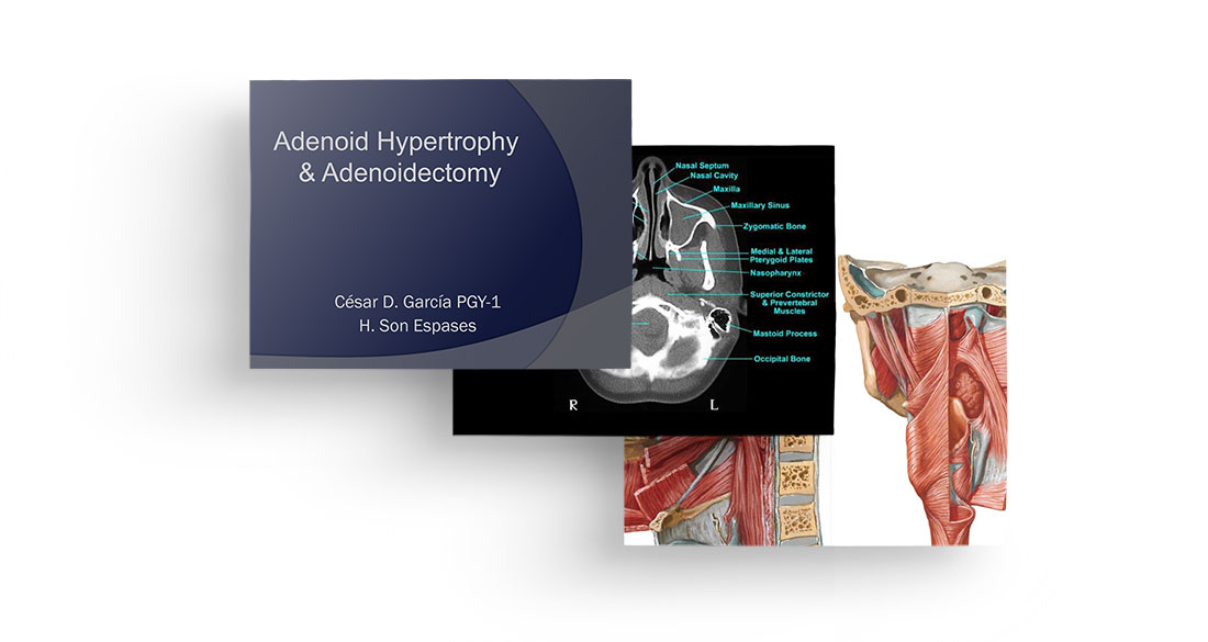 Adenoid hypertrophy & adenoidectomy