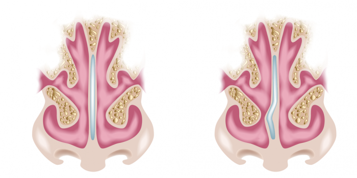 III Curso septoplastia Microscópica SBORL Sociedad Balear de