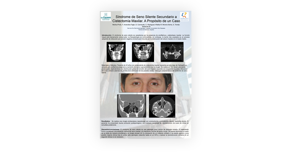 Síndrome de seno silente secundario a cistectomía maxilar. A propósito de un caso